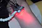 Laser Flächenbestrahlung